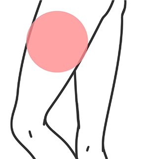 太ももの怪我・肉離れ